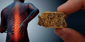بیماری خاموشی که استخوان‌هایتان را تهدید می‌کند